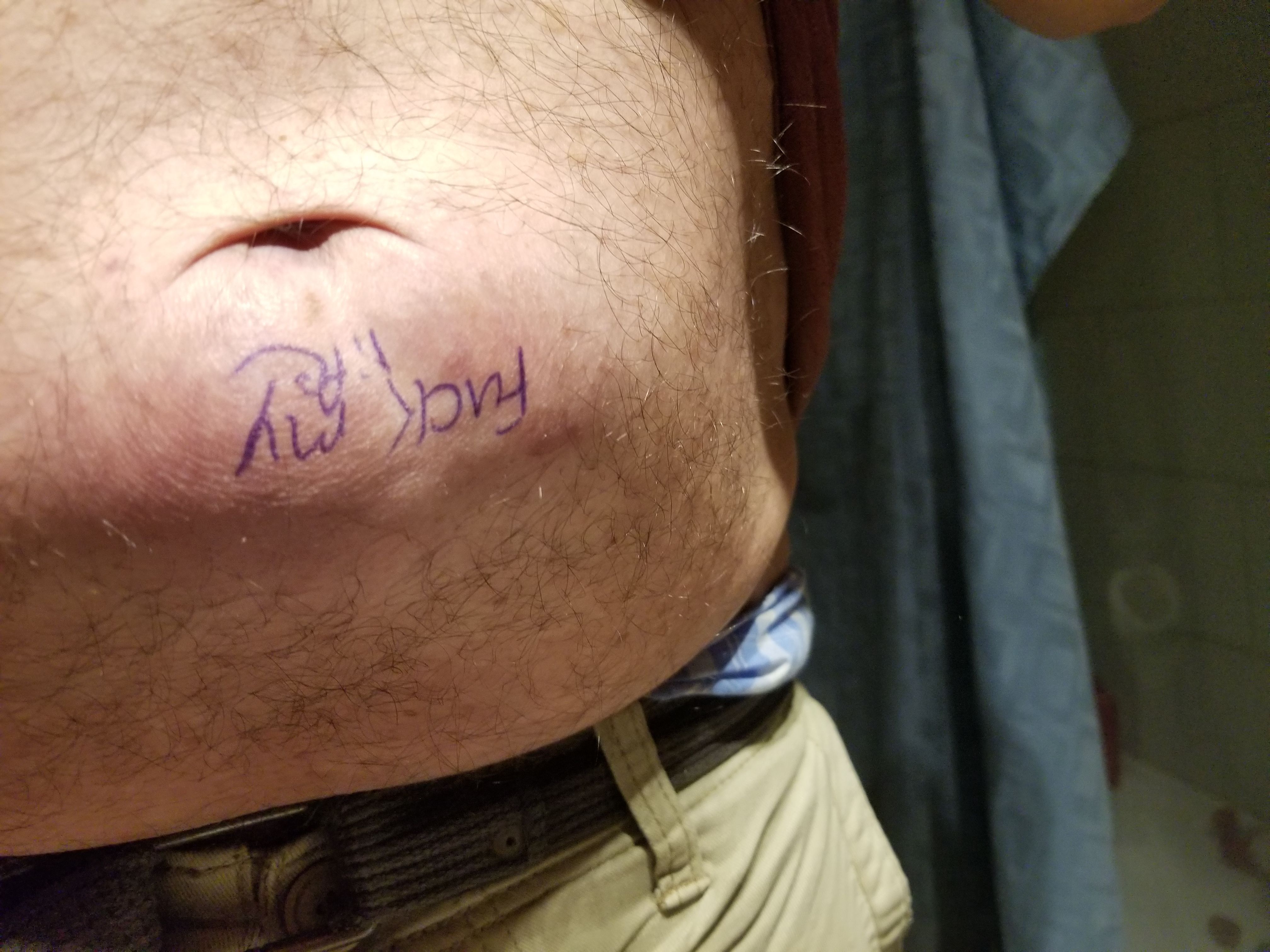 hernia.jpg