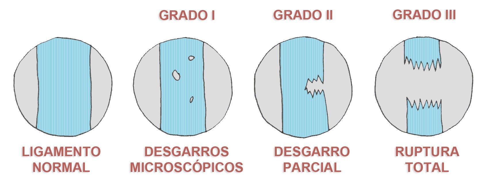 esguinces-grados.jpg