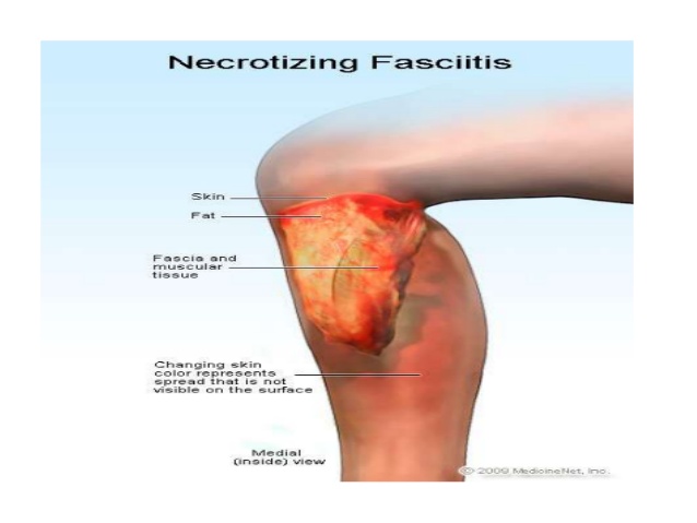 skin-and-soft-tissue-infections-29-638.jpg