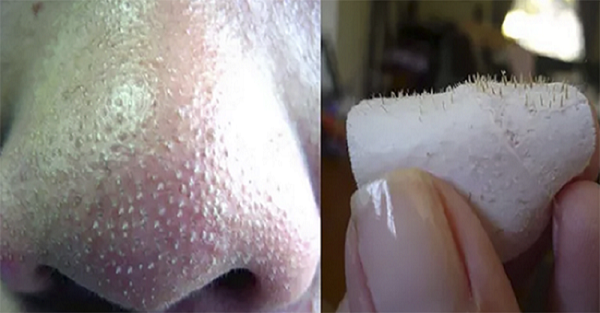 How To Get Rid of Blackheads on The Nose Fast at Home.png
