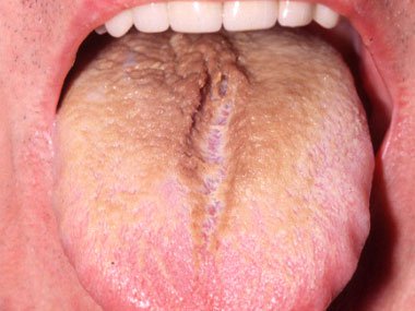 02-tongue-health-black-hairs-sl.jpg