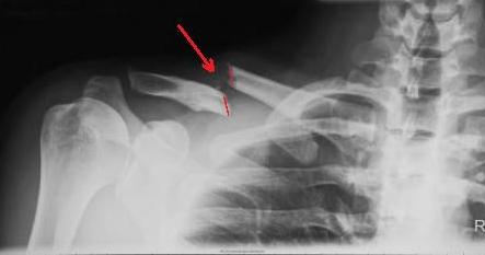 031012084841Clavicle fracture upclose.jpg