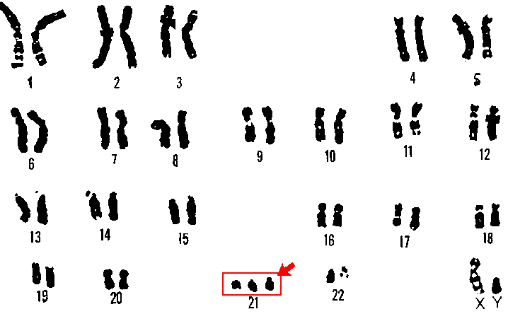 21_trisomy_-_Down_syndrome.png