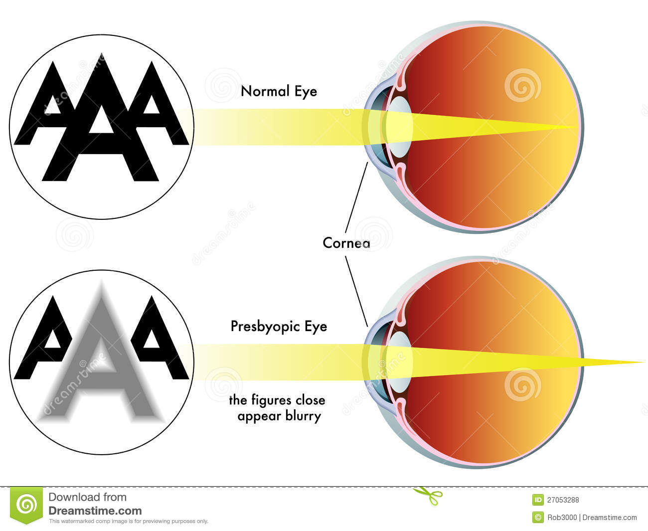 presbyopia-27053288.jpg