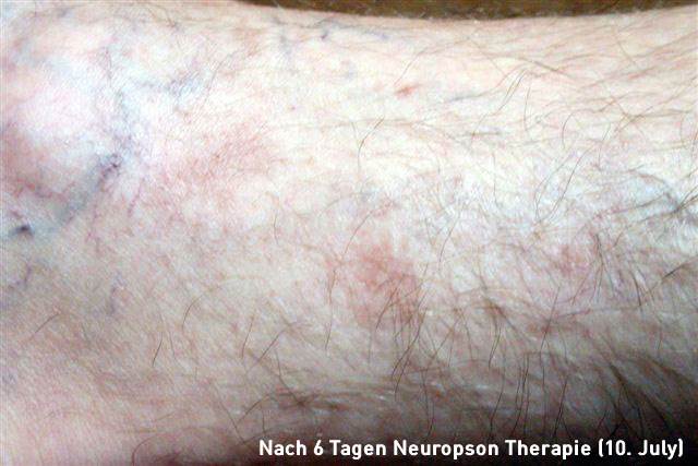 Hans-Brenner-Neuropson-Therapie-10Juli-2016-text.jpg