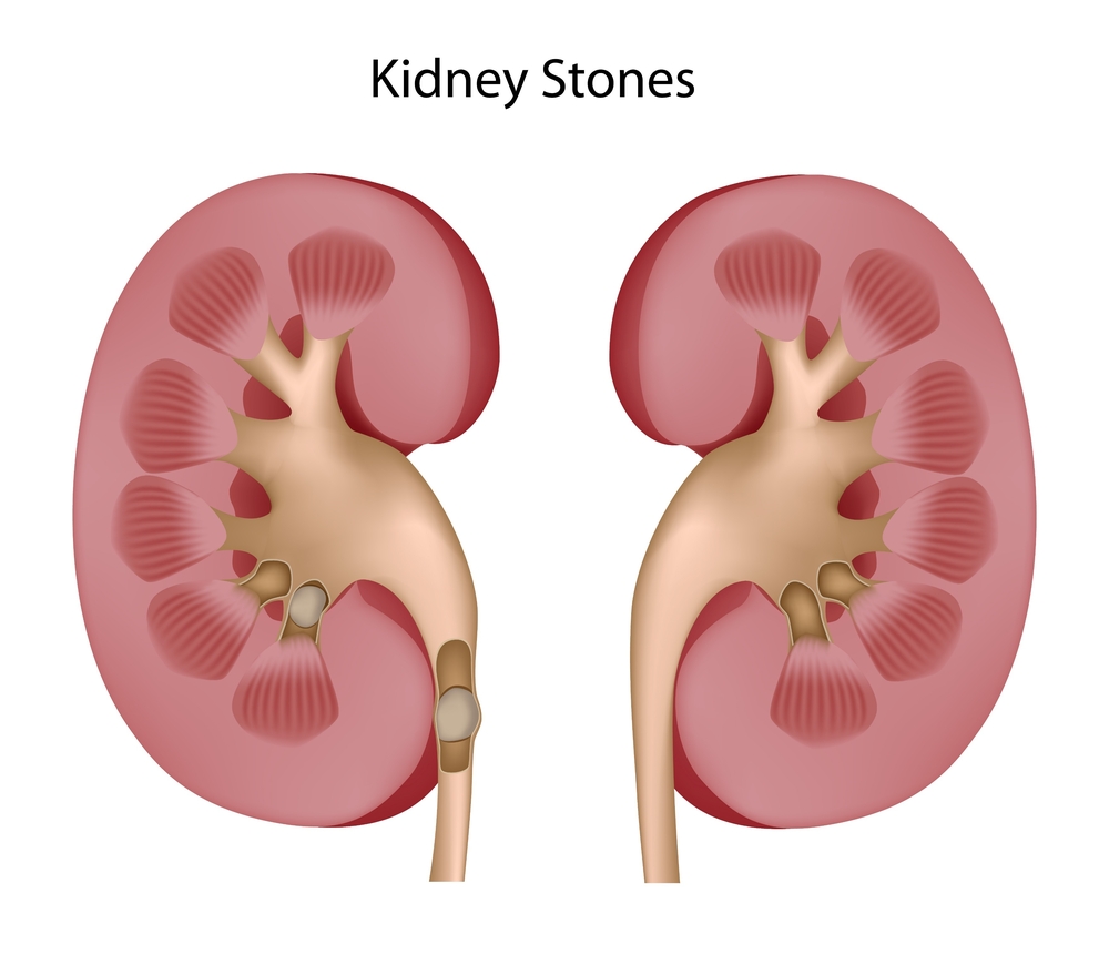 Kidney-Stones.jpg