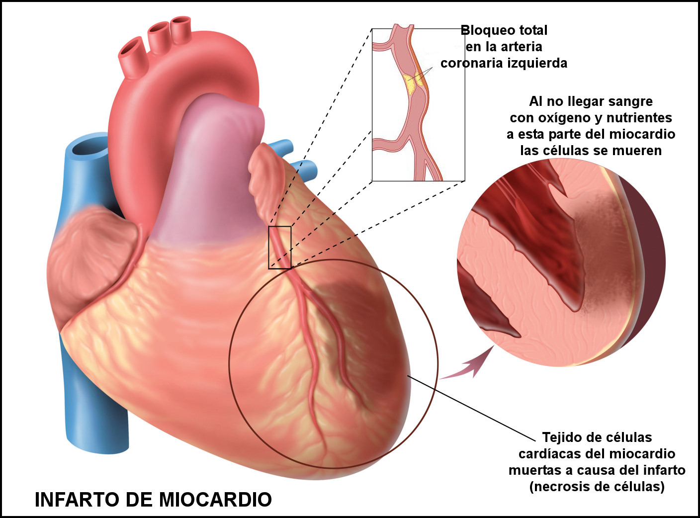 necrosis_infarto.jpg