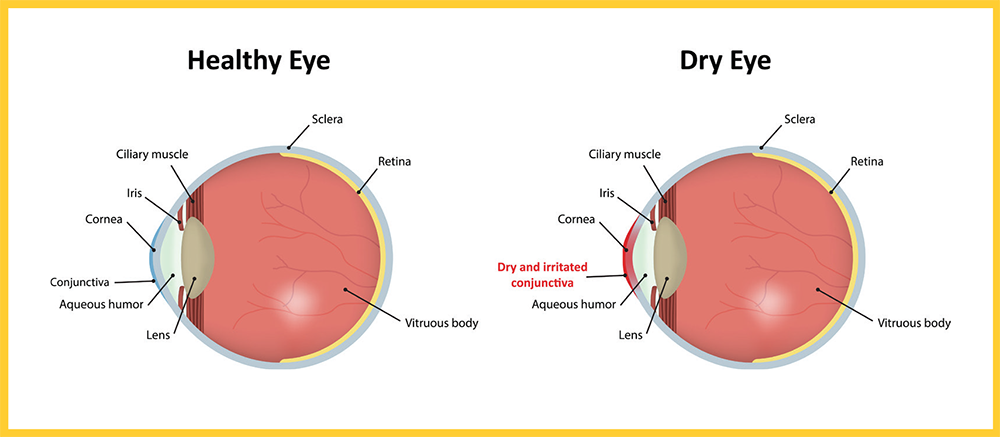 dry-eye-360-image.png