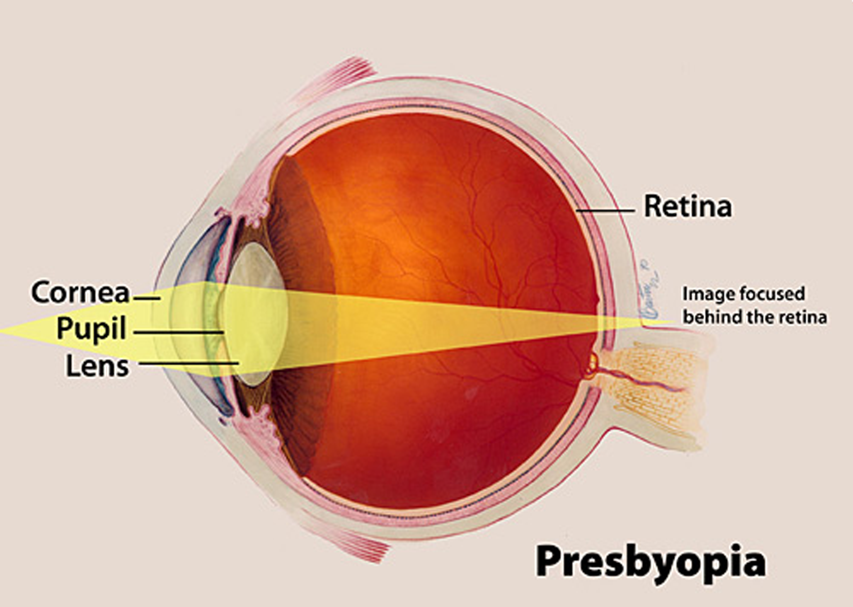 presbyopia.png