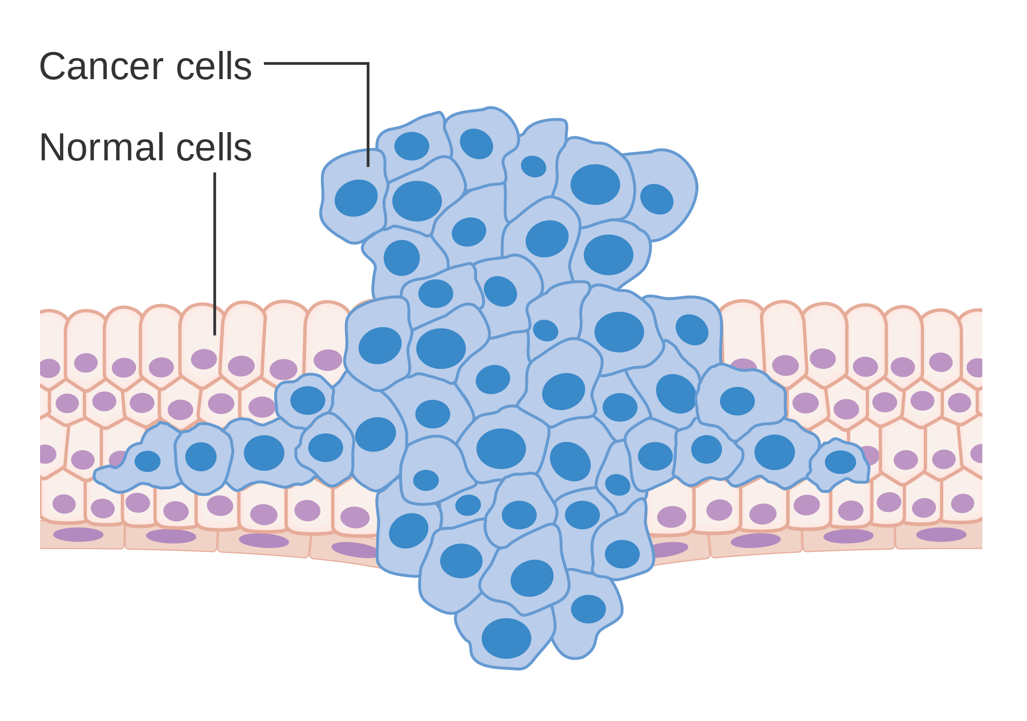 Formation of a tumor forcing its way into the adjacent tissues