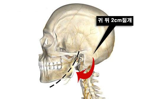 귀뒤사각턱 수술후기.jpg