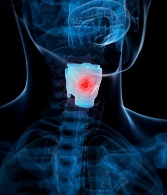 Throat-Cancer.jpg