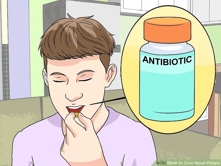 aid4692646-v4-728px-Cure-Nasal-Polyps-Step-5-Version-2.jpg