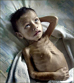 Malnutrition.jpg