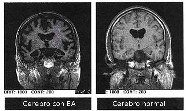 alzheimer27s_disease_-_mri-es.jpg