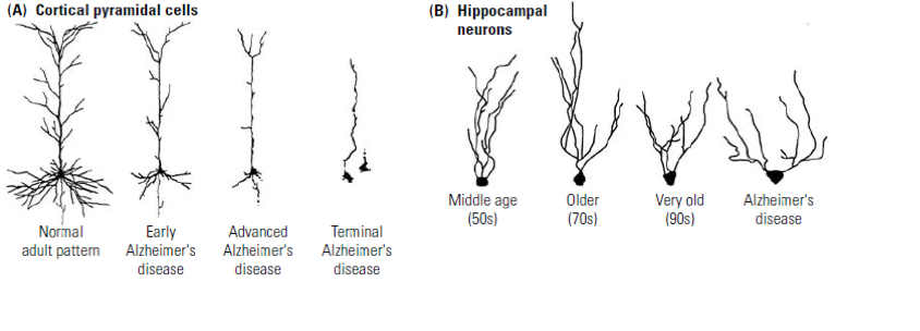 neuronias alzhaimer.png