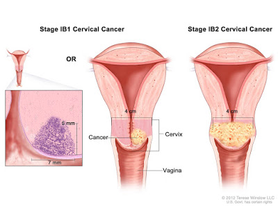 7 Signs Of Cervical Cancer That Women Need To Observe.jpg