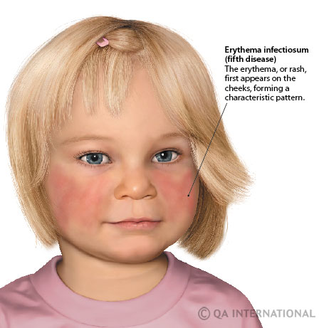 cabbage patch syndrome
