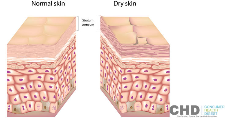 dry-skin.jpg