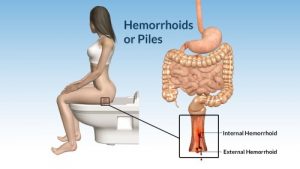 Hemorrhoids-500x281-300x169.jpg