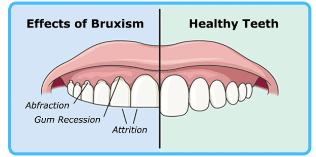 bruxism.png