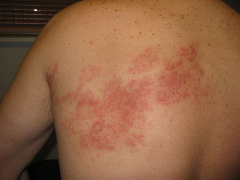 Herpes_zoster_rash_1_PI.jpg