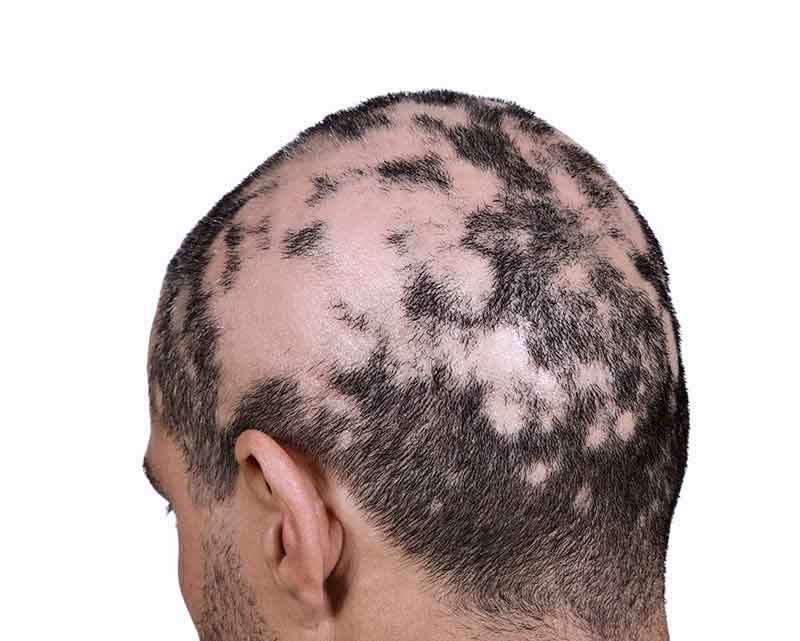 alopecia-areata.jpg