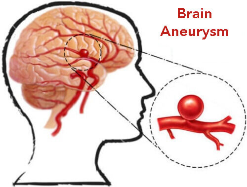 Brain-Aneurysm-1.jpg