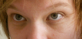 Dark_circles_(cropped).png