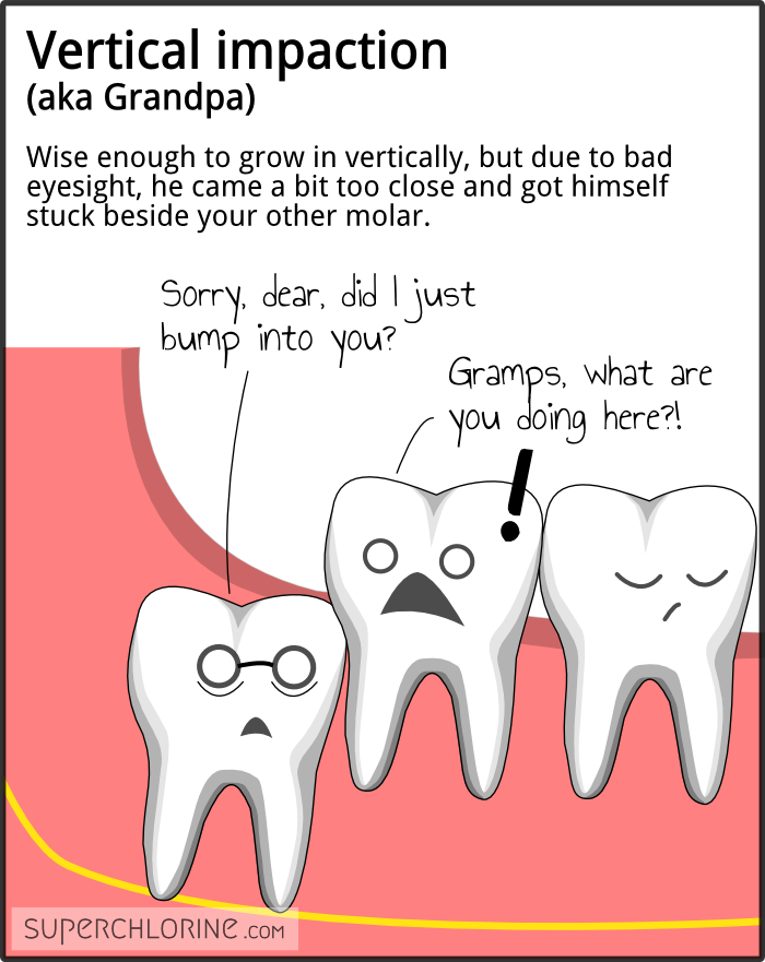 wisdom-teeth-types_vert.png