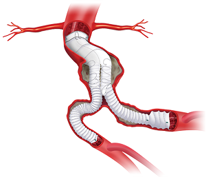 Aortic Stent Grafts.png