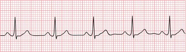 Normal_Sinus_Rhythm_Unlabeled_640x179.jpg