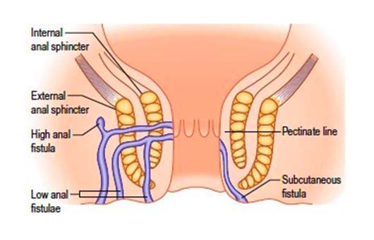 Safe Treatment Of Anal Fissure In Homeopathy Without Operation