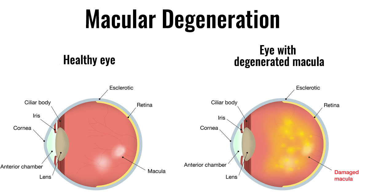 macular-degeneration.jpg