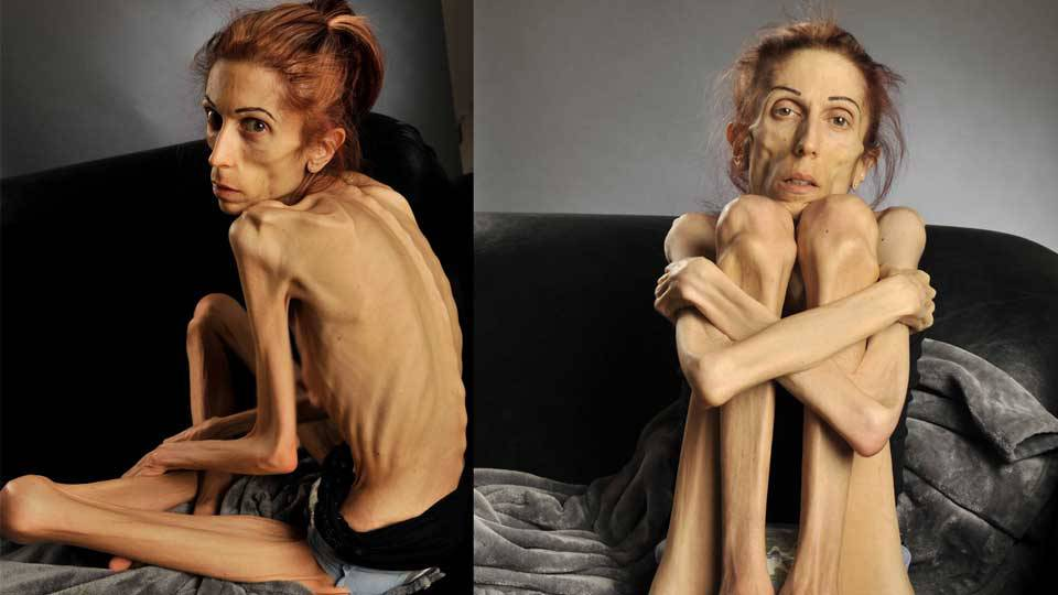 Resultado de imagen para El peor caso de anorexia de la historia, sobreviviÃ³ y asÃ­ luce 7 aÃ±os despuÃ©s.
