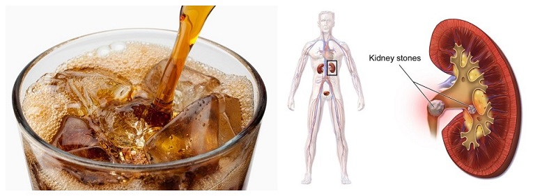 soda and kidney stone.jpg