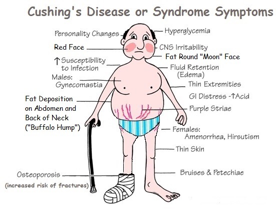 쿠싱증후군.jpg