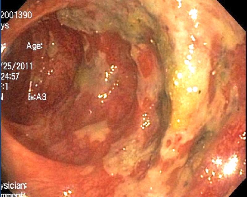 pseudomembranous_colitis1.86183307_std.JPG