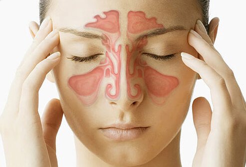 sinusitis_s1_woman_sinus_cavity.jpg