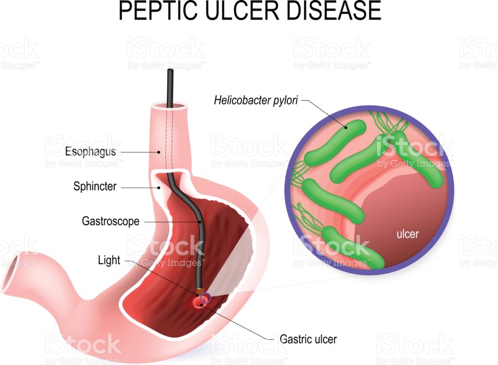peptic-ulcer-disease-stomach-ulcer-or-gastric-ulcer-vector-id645454524.jpeg