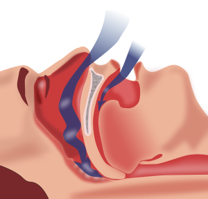 300px-Obstruction_ventilation_apnée_sommeil.svg.png