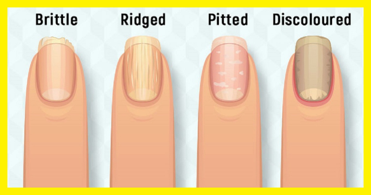 heres_what_your_fingernails_say_about_your_health_20180505124245.jpg
