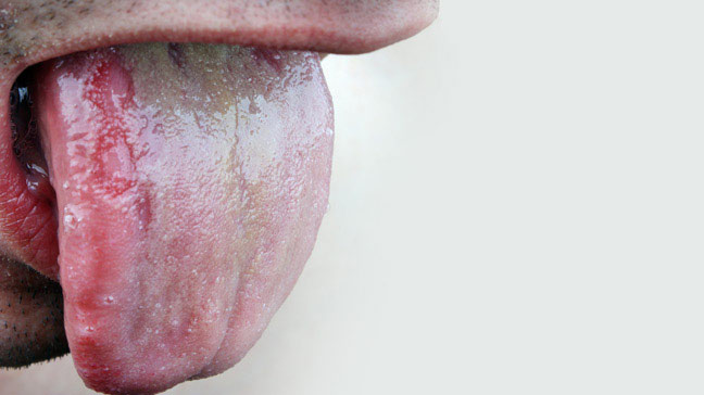 what causes thrush in your mouth