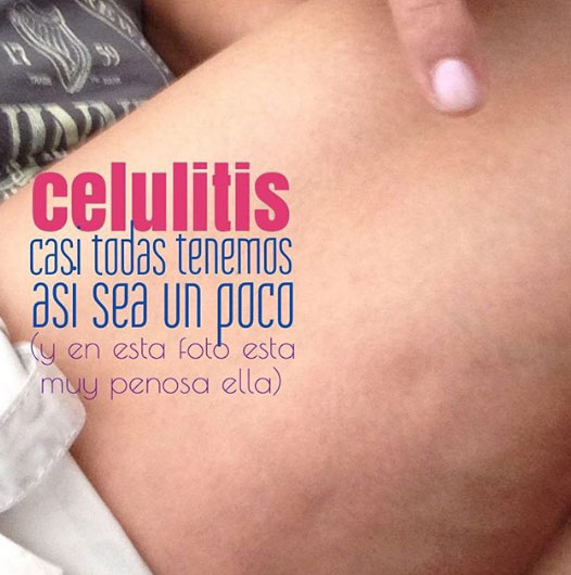 celulitis.jpg