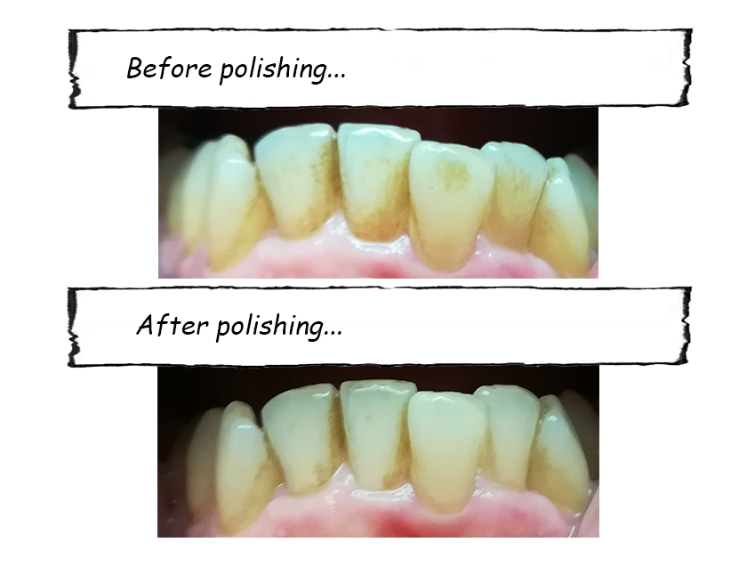 DIY_tooth_polisher_10.png