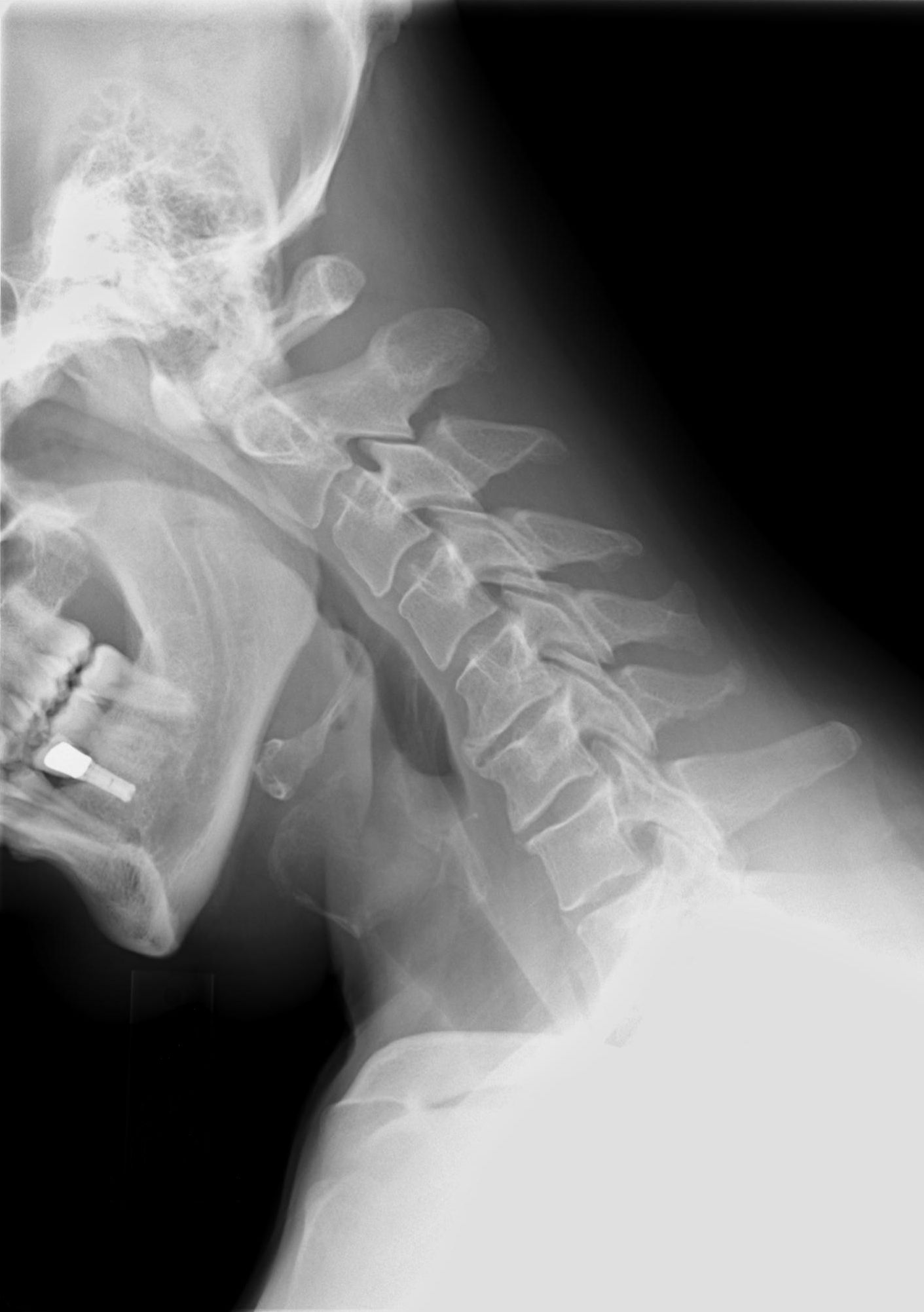 Cervical_Xray_Extension_view.jpg
