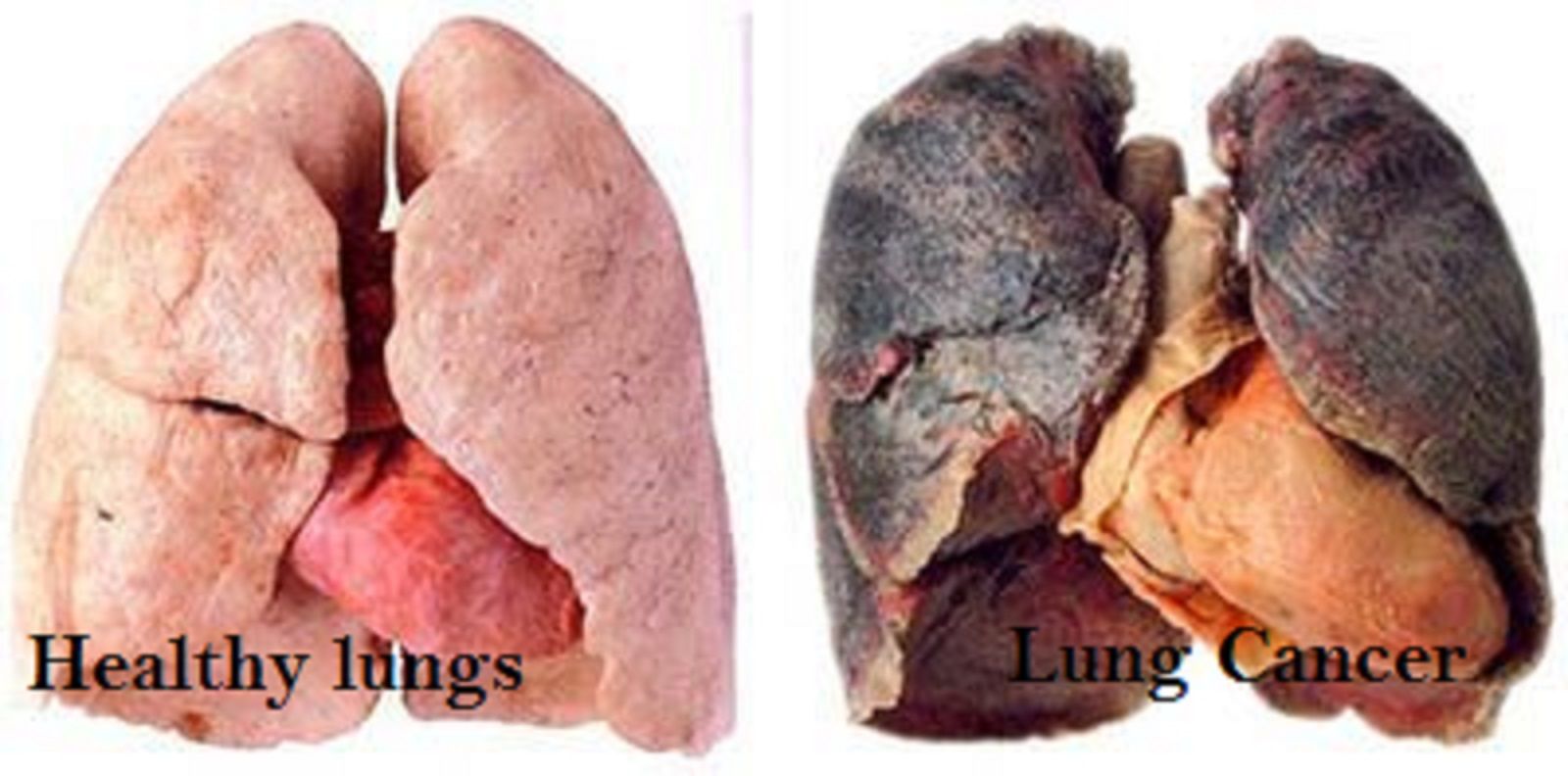 lung-cancer.jpg