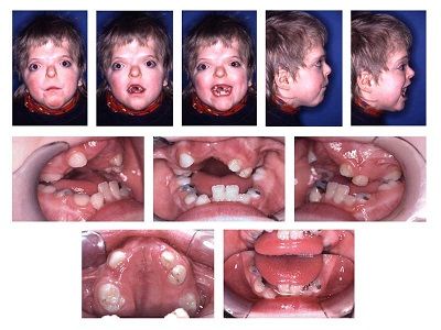 Patient_with_Apert_syndrome.jpg