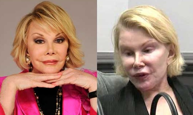 Joan-Rivers-worst-plastic-surgery-pictures.jpg