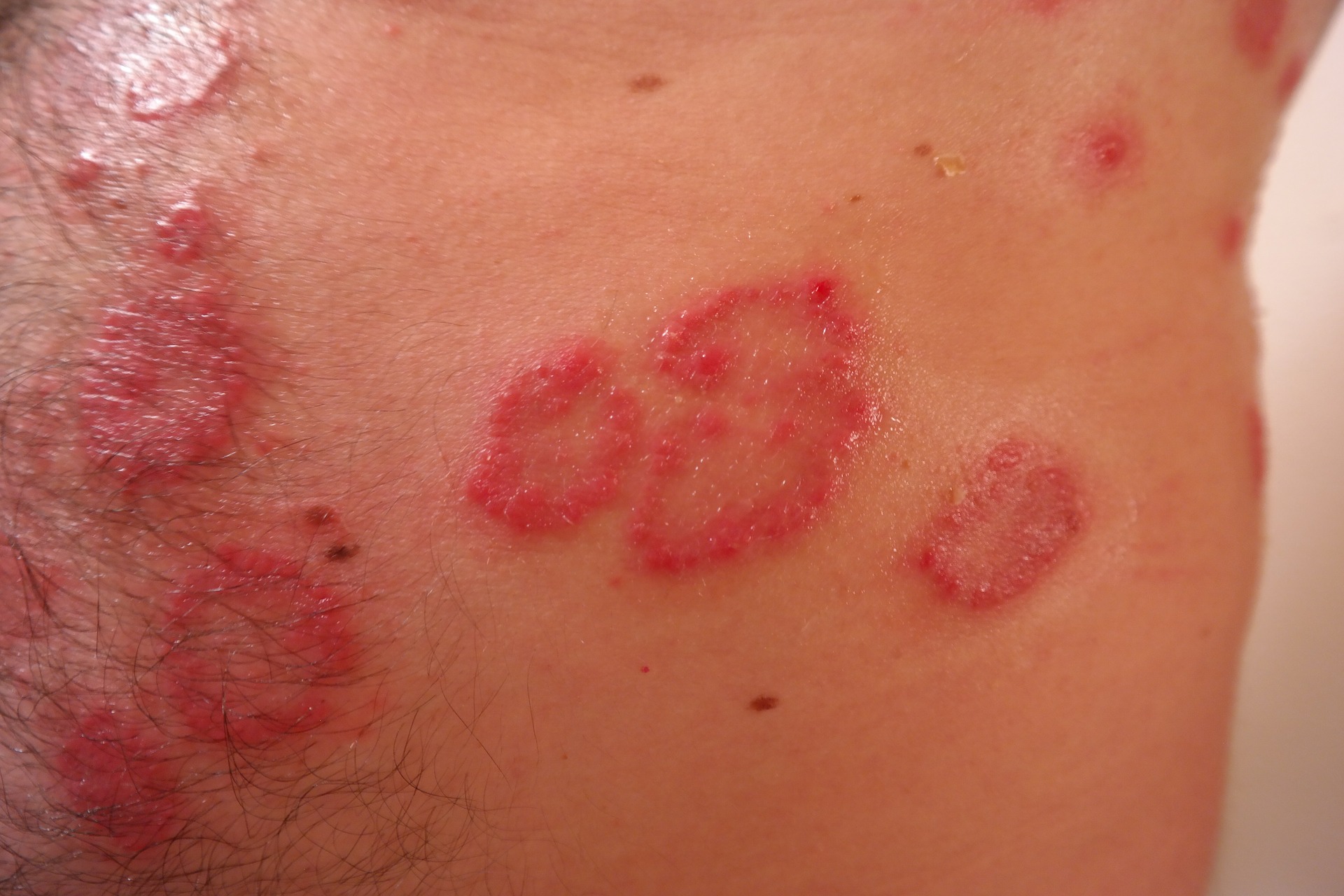 eczema.jpg